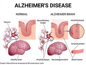 Alzheimer’s Disease Dementia NCLEX Quiz