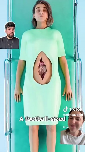 Understanding Colonic Inertia and Ostomy Bags