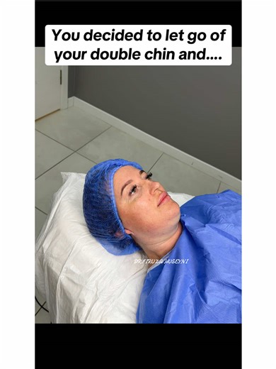 Double Chin Liposuction: Before and After Results