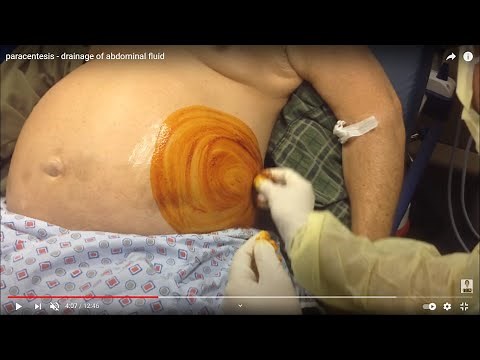 Ascitic fluid tapping technique, ASCITIC TAP PROCEDURE,PERITONEAL FLUID DRAINAGE,ABDOMINAL FLUID