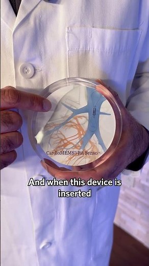 Cardiologist Shows the CardioMems Device