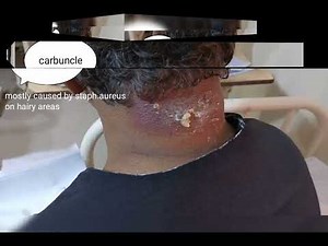 carbuncle with multiple sinuses discharge