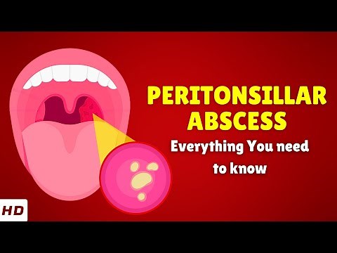 Peritonsillar Abscess – Causes, Signs and Symptoms, Diagnosis & Treatment