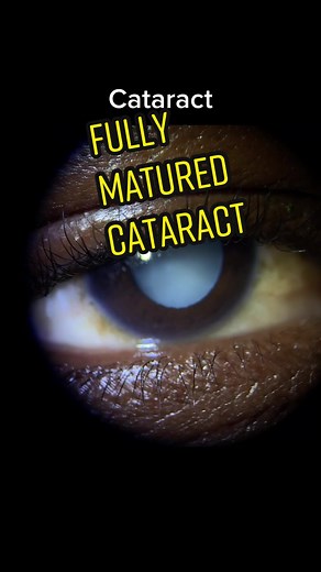 Fully Matured Cataract: Understanding Symptoms and Treatment