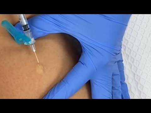 How To Give an Intradermal Injection | PPD | TB Test | Medical Assisting