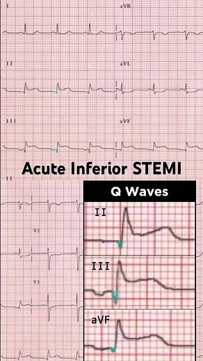 Acute Inferior ST elevation myocardial infarction (STEMI) ECG: Pathological Q waves