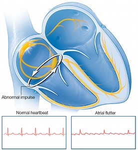 Atrial Flutter - Causes, Symptoms, Treatment & Ablation