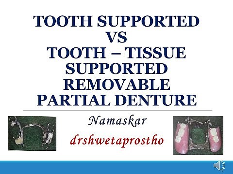 Tooth supported vs Tooth tissue supported RPD