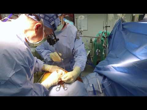 Minimally Invasive Bypass: A Better Way. Sanger Heart & Vascular Institute