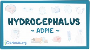 Hydrocephalus: Nursing process (ADPIE): Video, Causes, & Meaning | Osmosis