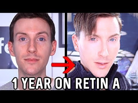 MY 1 YEAR RETIN-A RESULTS | BEFORE AND AFTER TRETINOIN