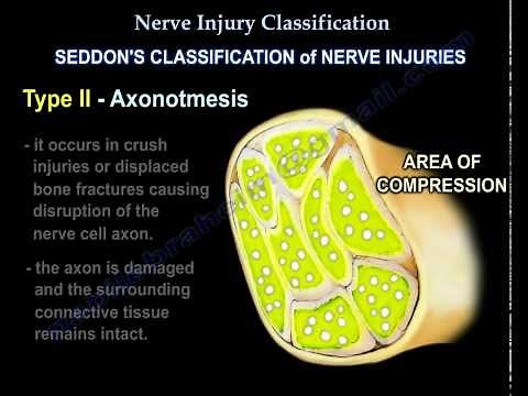 Nerve Injury ,types . Nerve recovery - Everything You Need To Know - Dr. Nabil Ebraheim
