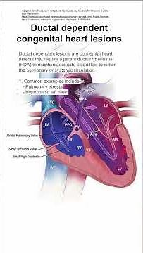 Ductal dependent congenital heart lesions