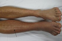 深部静脈血栓症のリハビリの注意点とリスクを把握しよう！