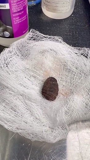 Huge Bot Fly Extraction from Patient's Neck