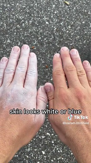 Understanding Frostbite: Causes, Symptoms, and Treatment Options