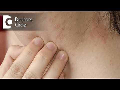 How to identify scabies rash & its management? - Dr. Sudheendra Udbalker