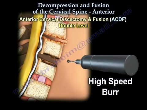 Cervical Spine ,Decompression And Fusion . - Everything You Need To Know - Dr. Nabil Ebraheim