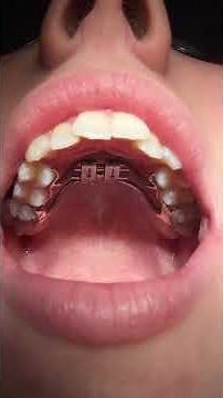 Patient Instructional Video Rapid Palatal Expansion Appliance Adjustment