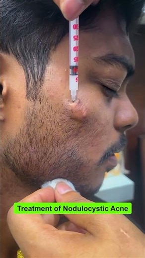 Treatment of nodulocystic acne || treatment of nodular acne