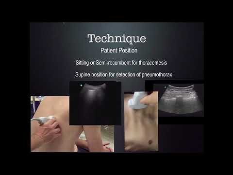 US Guided thoracentesis CUSE 2018