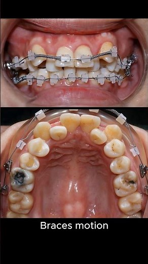 Braces to move super crooked teeth #braces #orthodontist #dentist #brackets #orthodonticd #dental