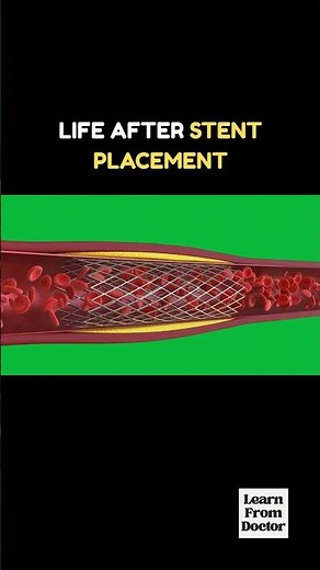 Life After Stent Placement | What Really Happens After Angioplasty