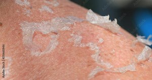 Sunburn - Closeup of Peeling sunburned skin on back and shoulder. Spending time in the sun damages the skin stock video