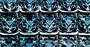 MRI Scan of the Spine