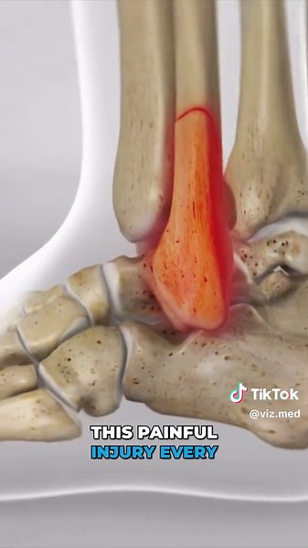 Ankle Fracture Surgery: Open Reduction and Internal Fixation