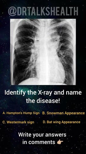 “Only 1% Can Identify This X-ray Sign 😳 | Spot Diagnosis Challenge” #chestxray #doctor #healthtips