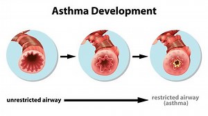 Animation Asthma Development Explanation Stock Footage Video (100% Royalty-free) 1100718071 | Shutterstock