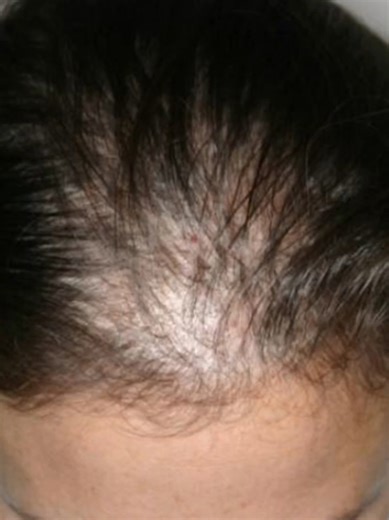 Preparation of Ayurvedic Herbal Shampoo Explained