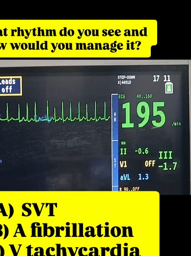 What's the ECG Rhythm? Cardiology Nurse EKG Guide