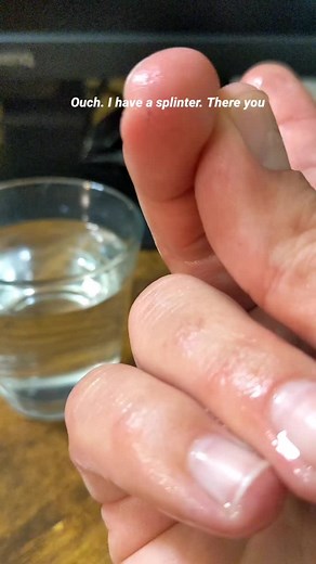 Easy Splinter Removal Technique Using Hot Water
