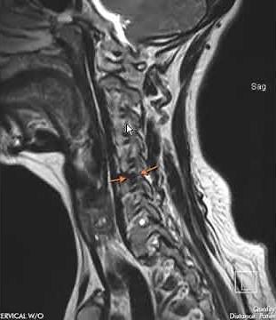 Typical disc herniation of cervical spine