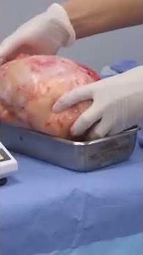 A Shocking Discovery After Weight Loss! | Dr Pimple Popper TLC