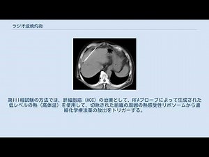 ラジオ波焼灼術