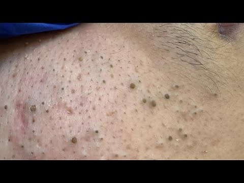 ACNE TREATMENT • DEEP CLEANSING TECHNIQUES • CLEAR SKIN ROUTINE