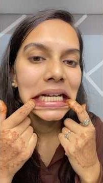 Does teeth will move back after retainer removal ?#braces#teeth#orthodontics#bracesgirl