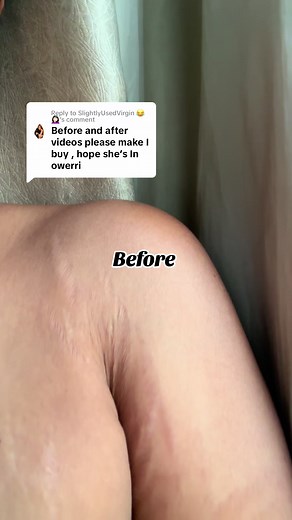 Effective Stretch Mark Removal Treatments Revealed