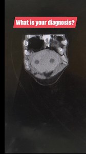 230 reactions · 20 shares | A 40 year old Man present history of alcoholic x 7-8 years alternate 1/4 (quator).. Pain in Rt Hypochondriac region with loss of appetite. And weight loss continued..CECT- Abd Coronal view present with multiple hypodence lesion in liver. What is your diagnosis..? . . . . #reelschallengereelschallenge #fbpost2025シ #fbyシvideo #CT #mbbs #radiology #Radiologia #radiologist #mbbsstudent #gastritis #LiverCare #liverdisease #medico #medicos | Diwakar Patel | Facebook