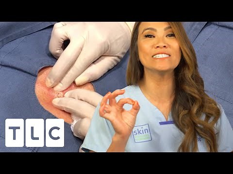 "I'm Like a Cyst Sleuth" Dr Lee Investigating Deep Epidermoid Cysts | Dr. Pimple Popper: This Is Zit
