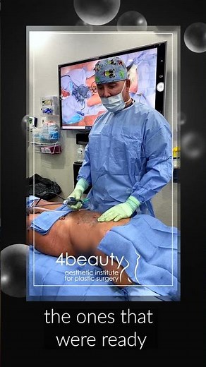 SafeLipo Method in Liposuction and BBL Surgery | OR Video with Dr. Mendieta in Miami