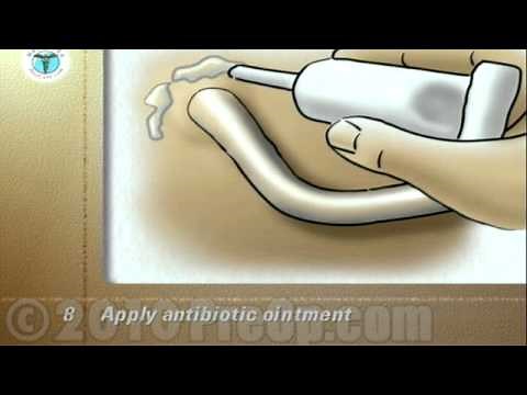 Care of Suprapubic Catheter PreOp® Patient Education
