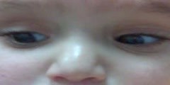 A Baby Suffering Congenital Nystagmus