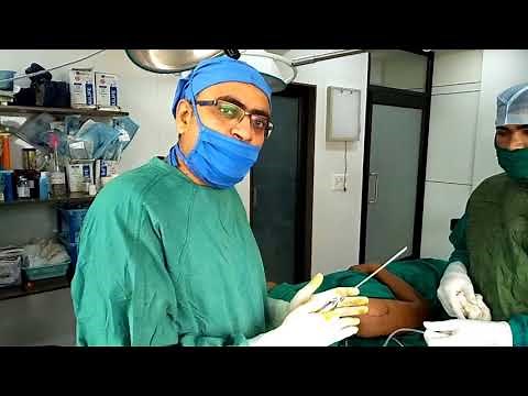 Liposuction Procedure for Lipoma by Dr. Chintan Patel - M.S., M.Ch., (Plastic Surgeon)