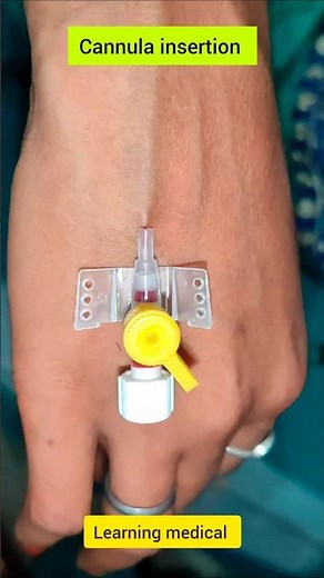 cannula insertion | cannulation