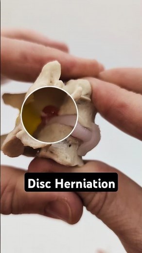 Cervical Disc Herniation Model