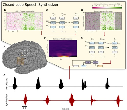 Online speech synthesis using a chronically implanted brain–computer interface in an individual with ALS - Scientific Reports
